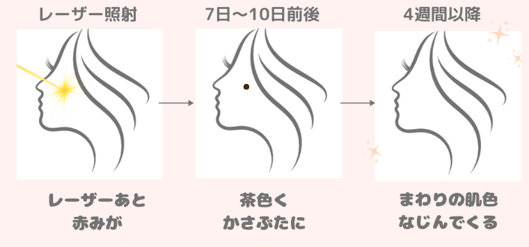 シミ取りのダウンタイムの経過