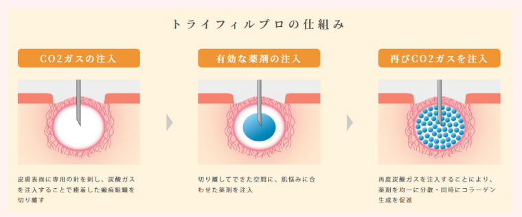 ルラ美容クリニックのトライフィルプロ・ドラッグデリバリー