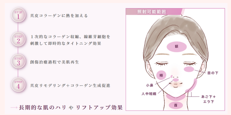ルラ美容クリニックのオリジオキッス施術部位料金