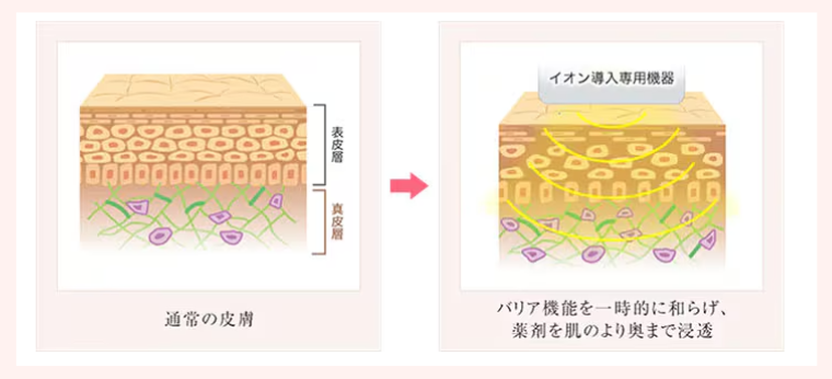 イオン導入