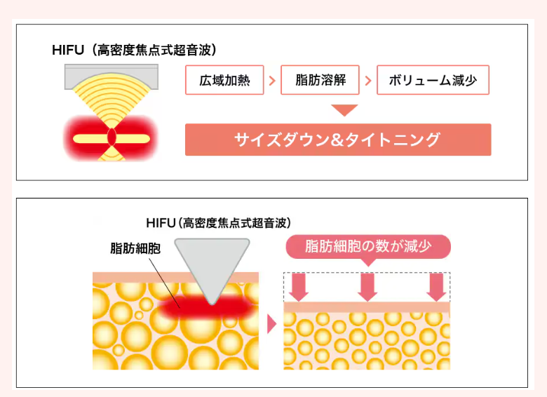 リニアハイフ