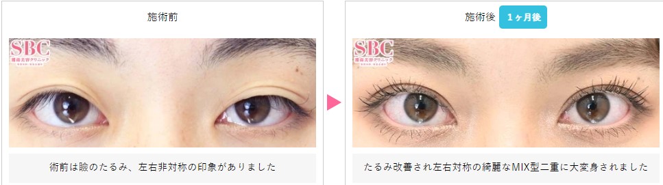 SBC症例写真