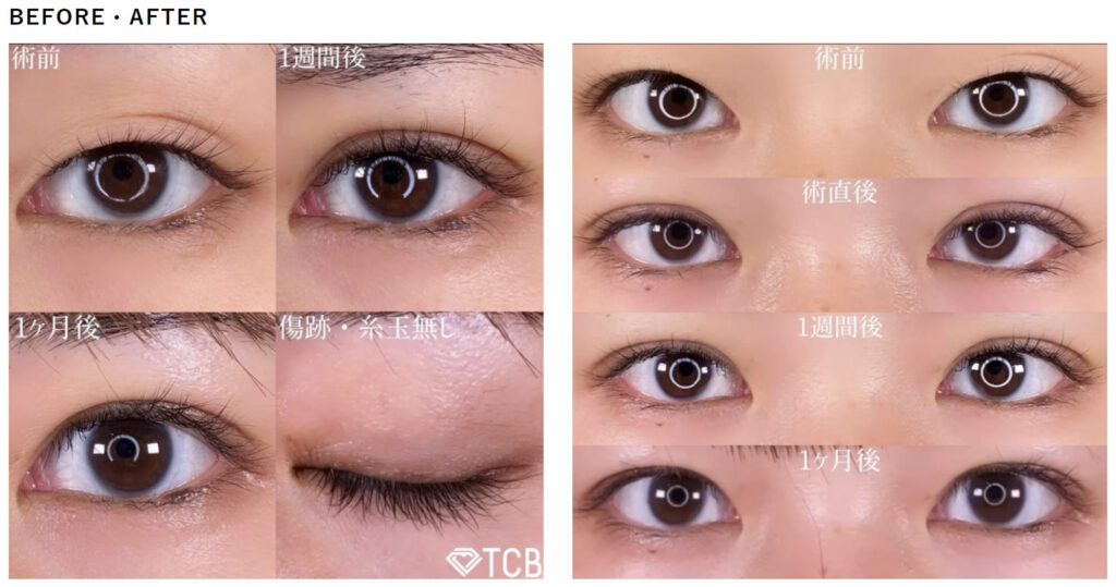 TCB二重整形症例写真（埋没法）