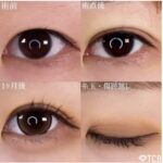 TCB二重整形症例写真（埋没法）