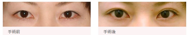 札幌中央形成外科二重整形症例写真