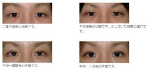 札幌美容形成外科二重整形症例写真