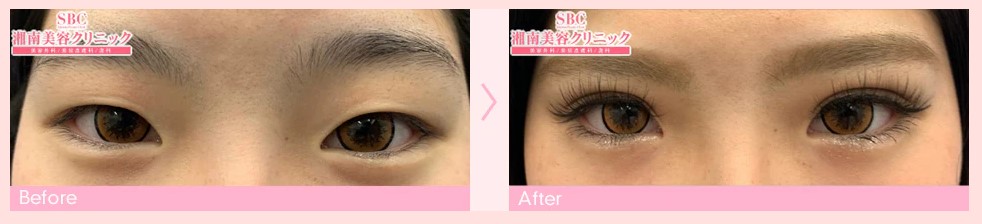 湘南美容クリニック札幌院・札幌大通院二重整形症例写真