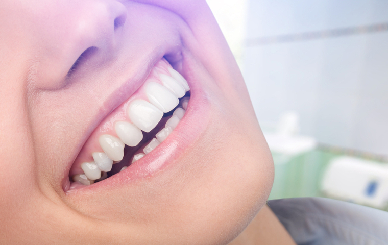 都城市　ホワイトニング