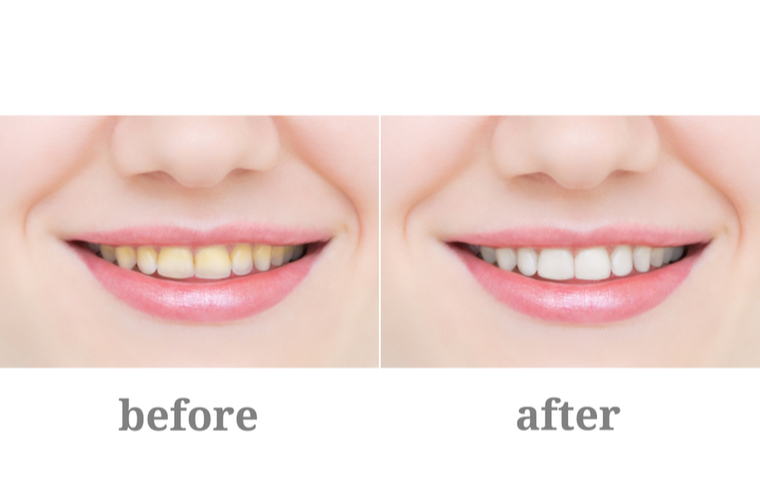 ホワイトニングのビフォーアフター