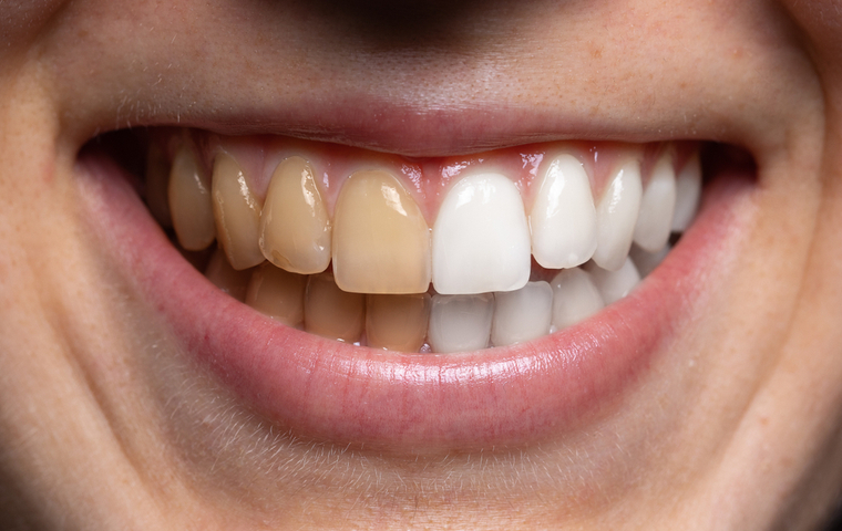 ホワイトニングビフォーアフター