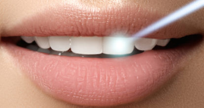 ホワイトニング