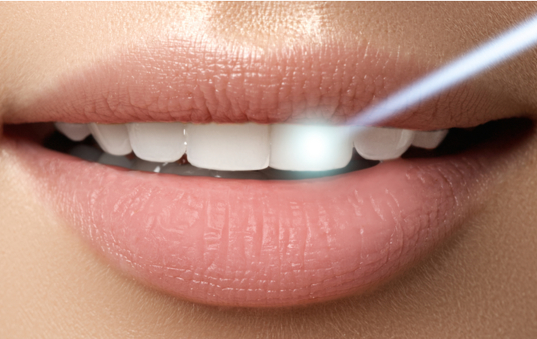 ホワイトニング