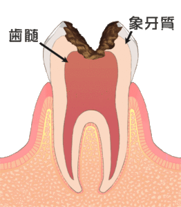 武蔵小杉コモンズ歯科　むし歯　C3（神経まで進行した虫歯）