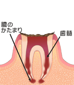 武蔵小杉コモンズ歯科　むし歯　C4（歯の根まで進行した虫歯）